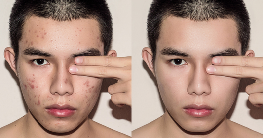 Complete acne skincare routine featuring Klysee face care products